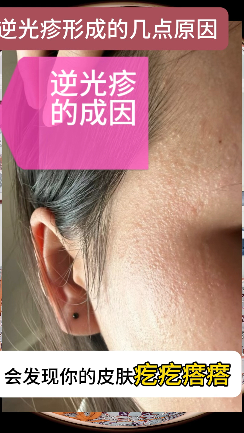 逆光疹五点形原因