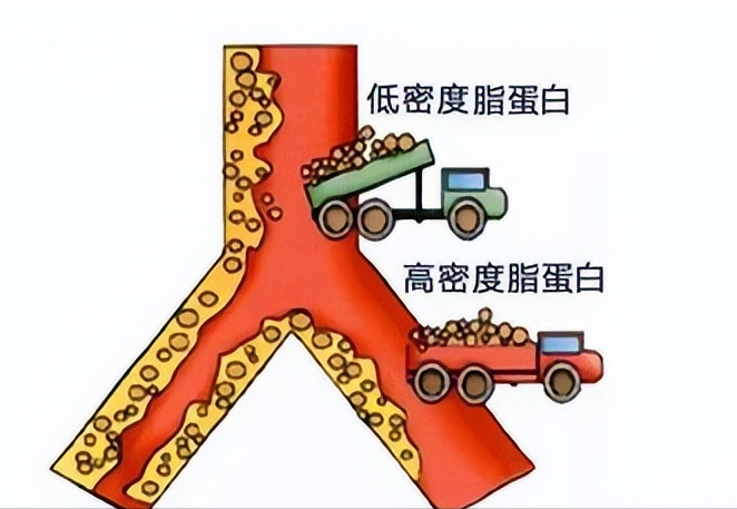 低密度脂蛋白要低于多少,斑块才能不发展?医生告诉你答案