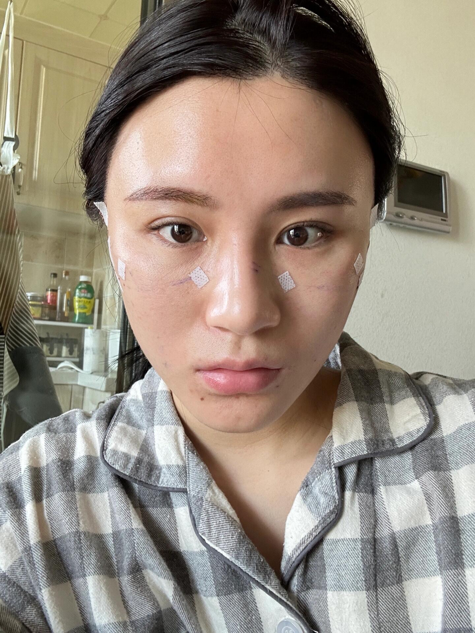 无痕筋膜提升第2天,老公说不如不做  目前第二天,基本不怎么肿,有点