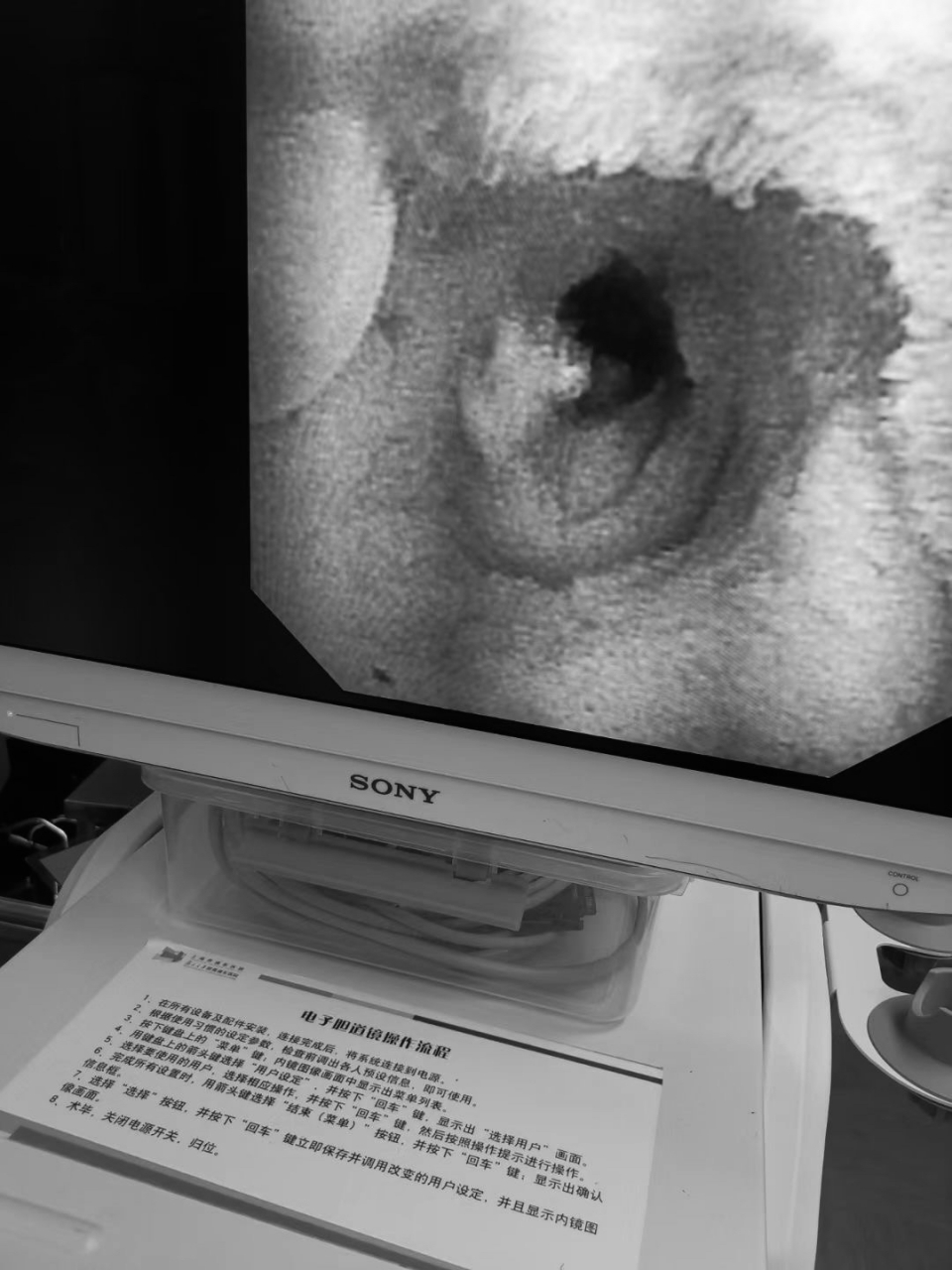 肝硬化脾亢血小板下降患者,今日单孔腹腔镜,通过一个小孔切除肿大脾脏