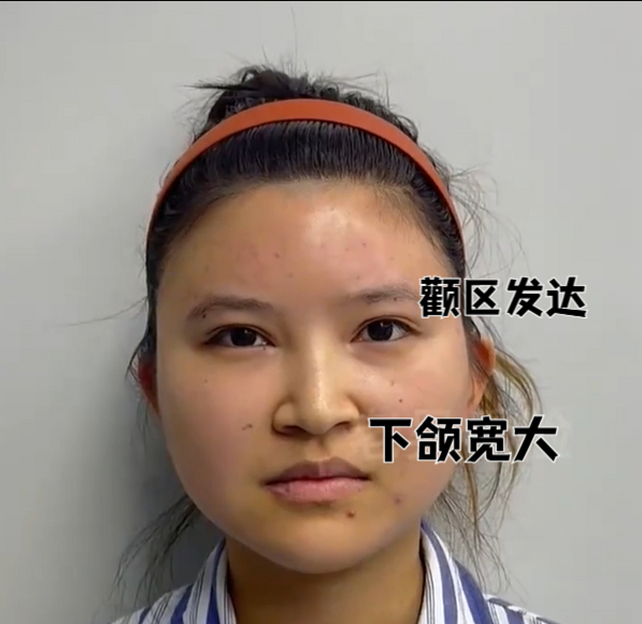 美者,她被自己的面部问题困扰了很久,这次专门到郑州找到我帮她改脸型