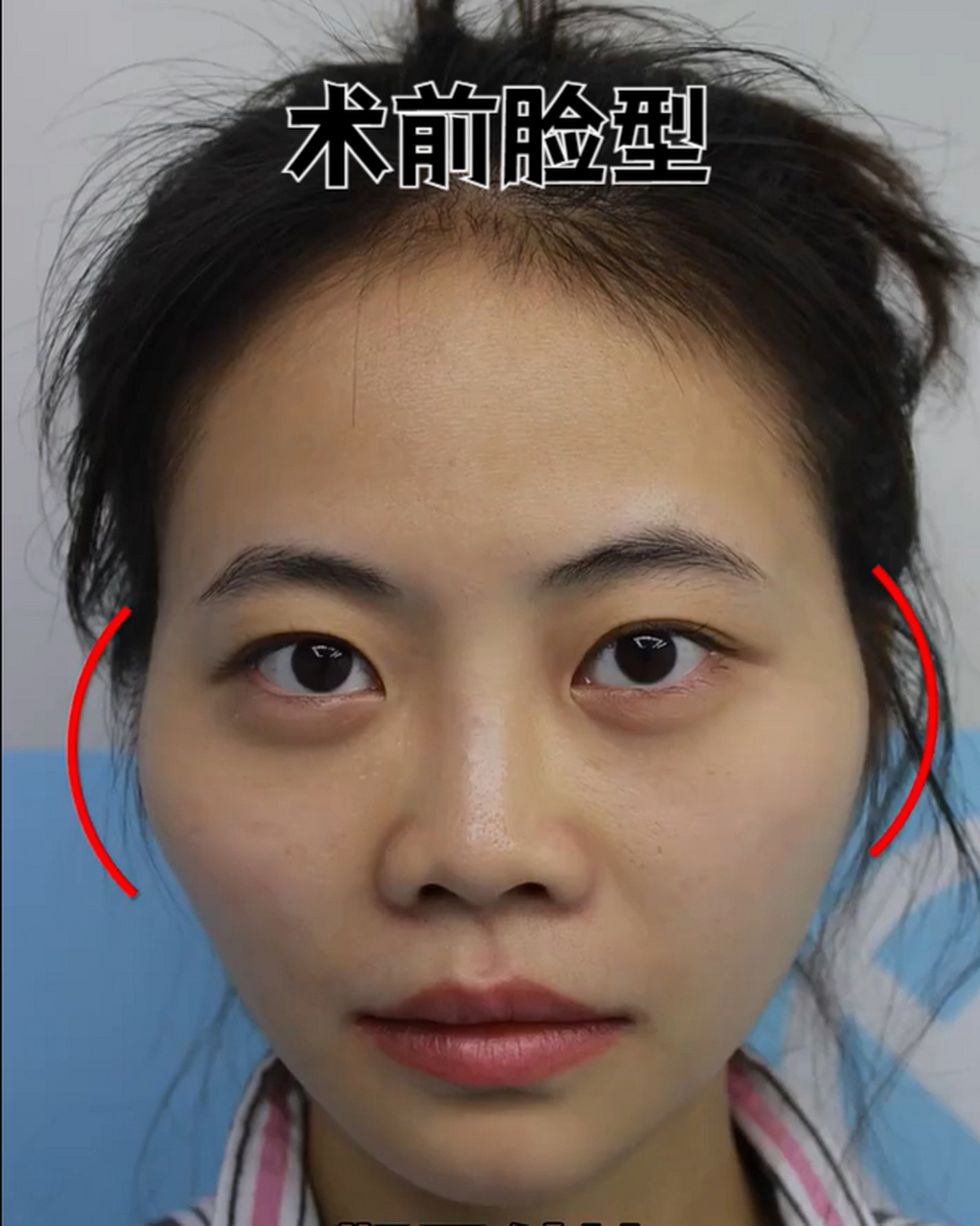 这个小姐姐很可爱,可惜长了一个菱形脸,她很在意,高突的颧骨,凹陷的