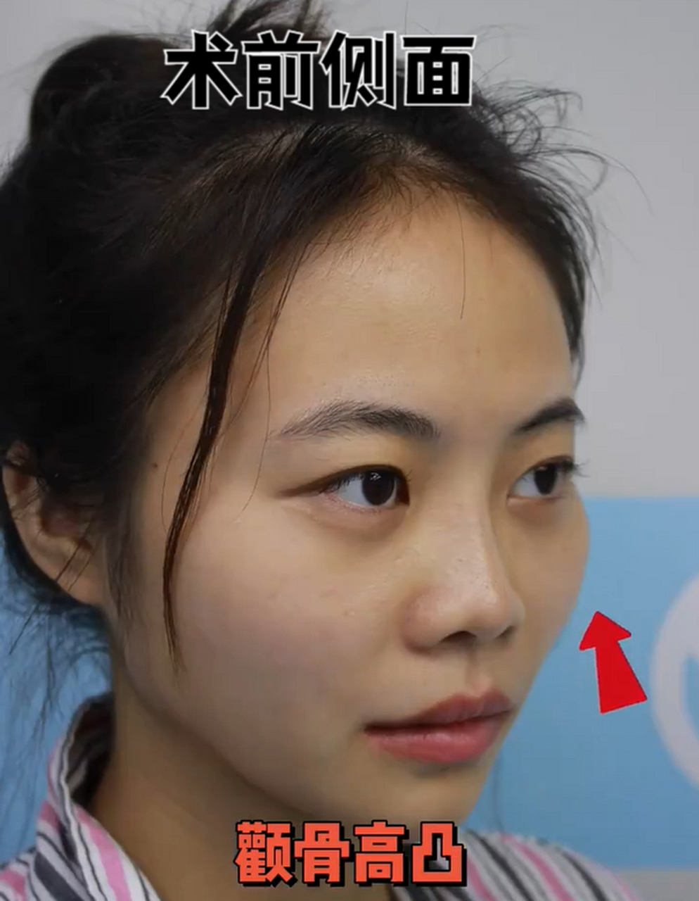 这个小姐姐很可爱,可惜长了一个菱形脸,她很在意,高突的颧骨,凹陷的