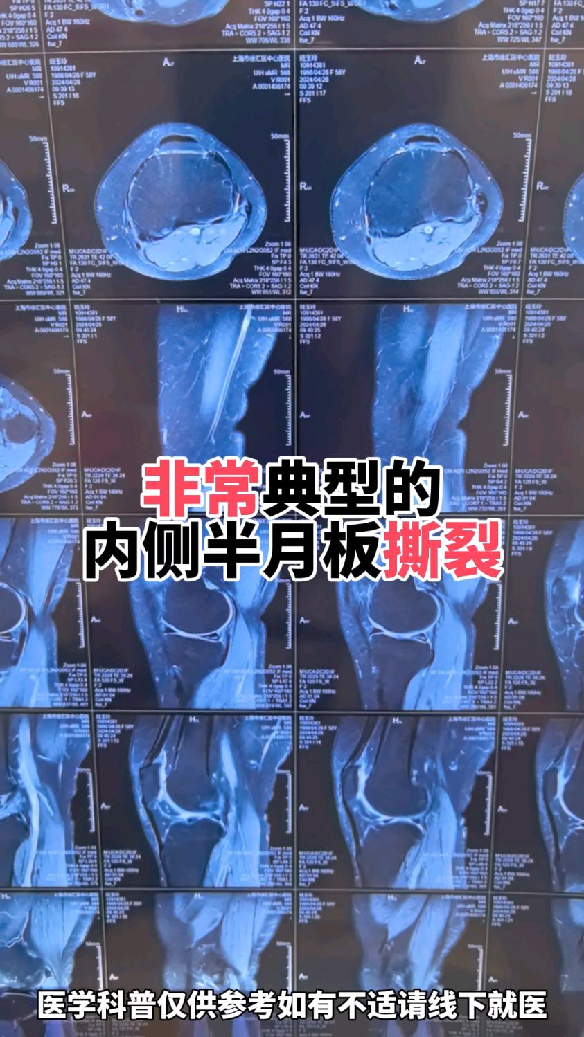 内侧半月板撕裂的磁共振表现