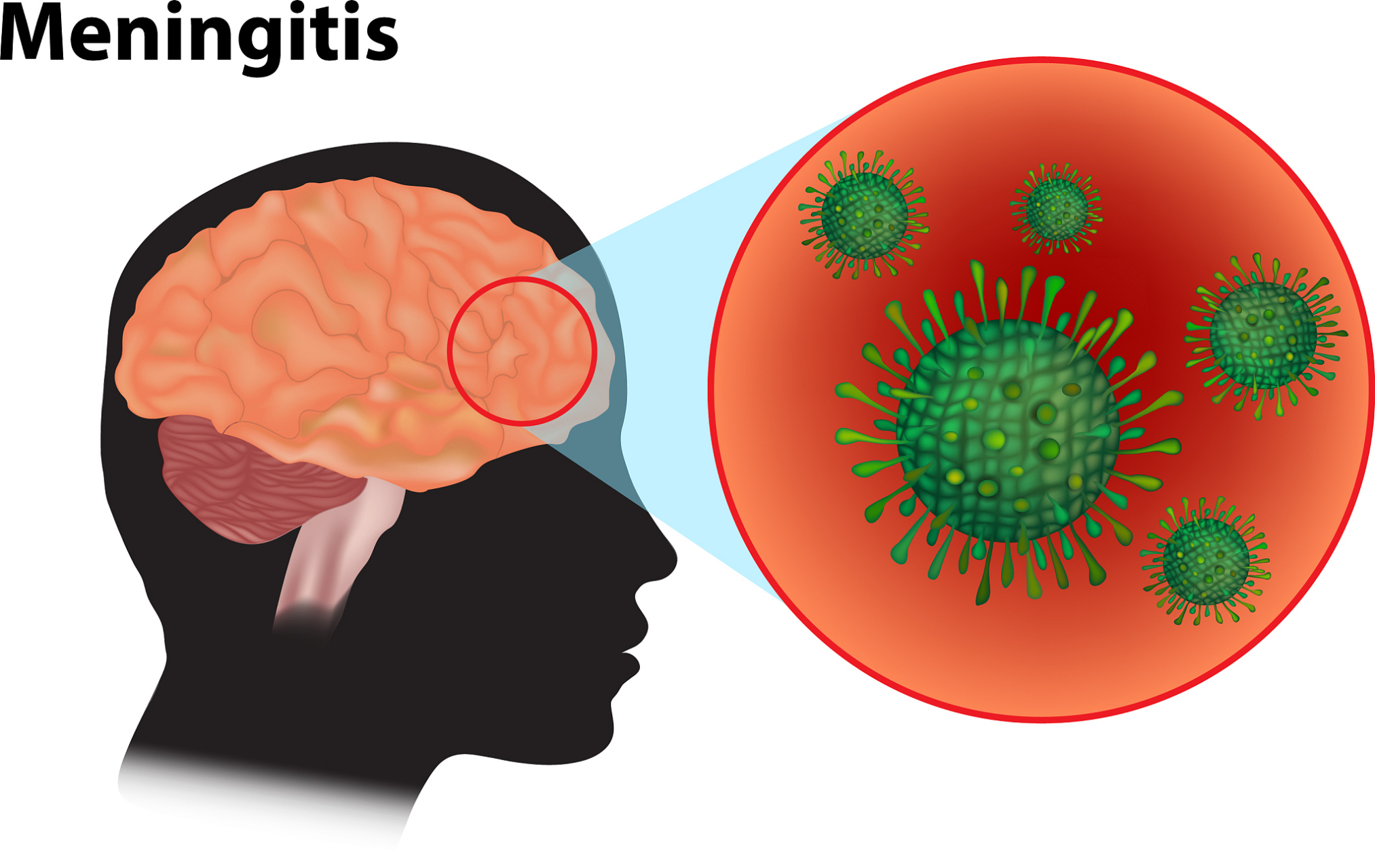 45岁男子,头痛以为是感冒,医生:是脑膜炎,只因忽略了1种病毒