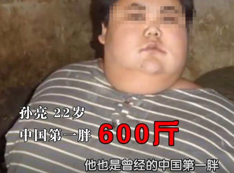 2014年,江西14岁男孩胖到300斤,医生查出罕见病,手术意外连连