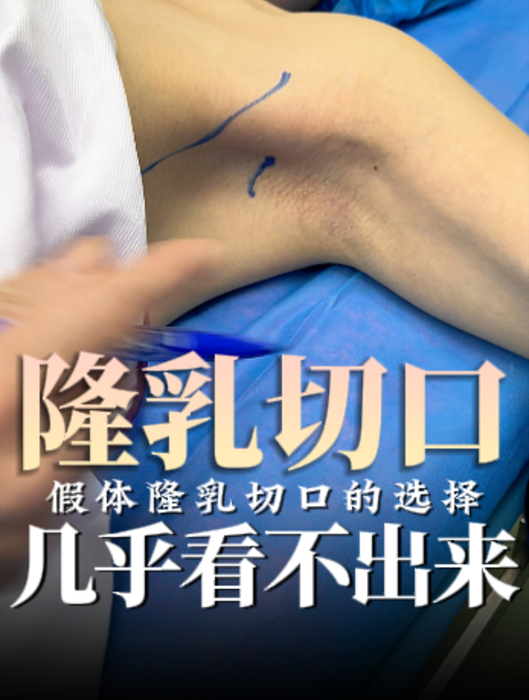 隆乳切口会很明显嘛?一起来看看小姐姐的恢复情况吧 假体丰胸