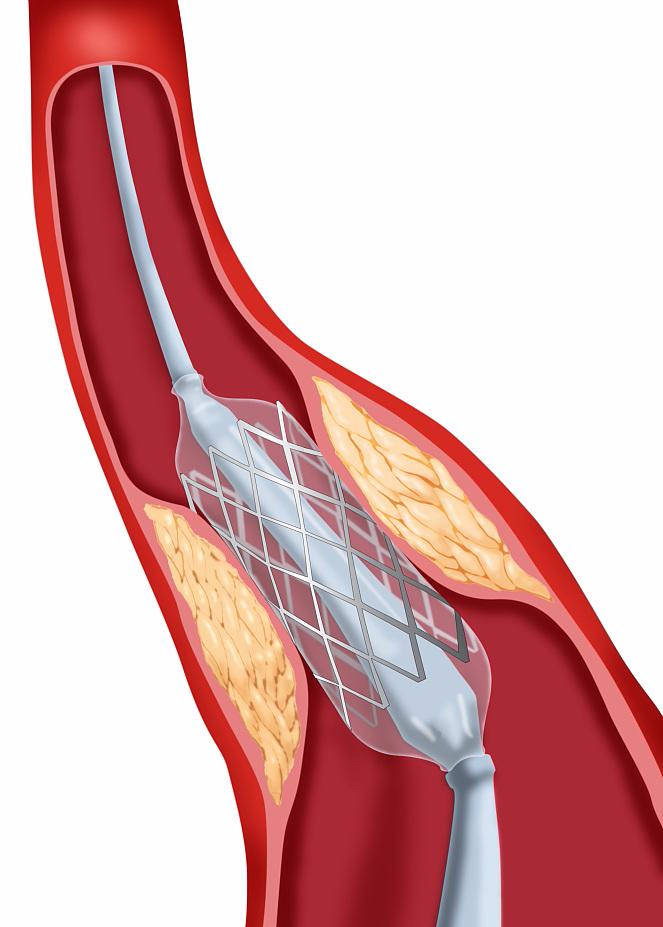 心脏支架球囊图片图片