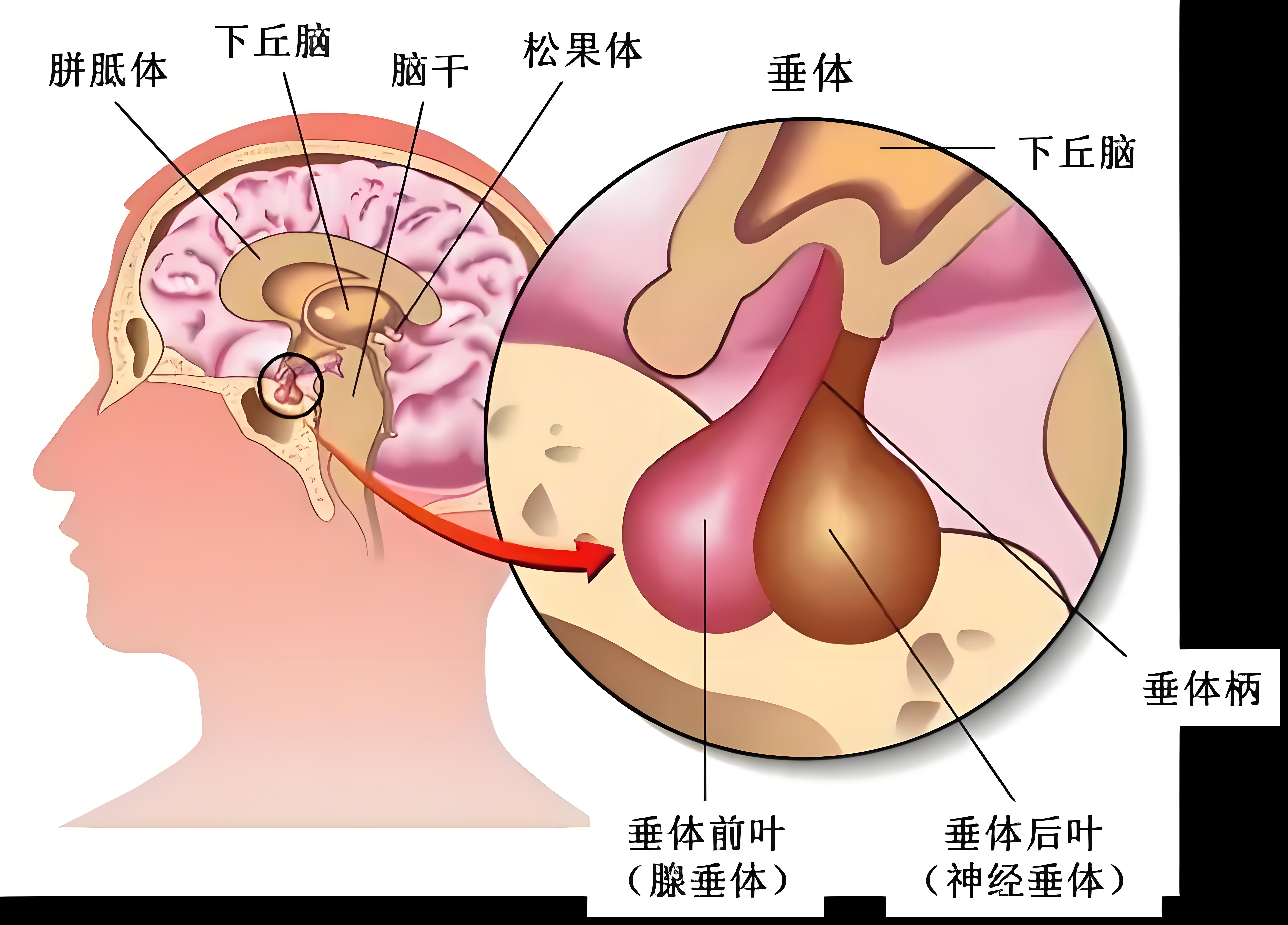 脑垂体瘤的分类是怎样的?