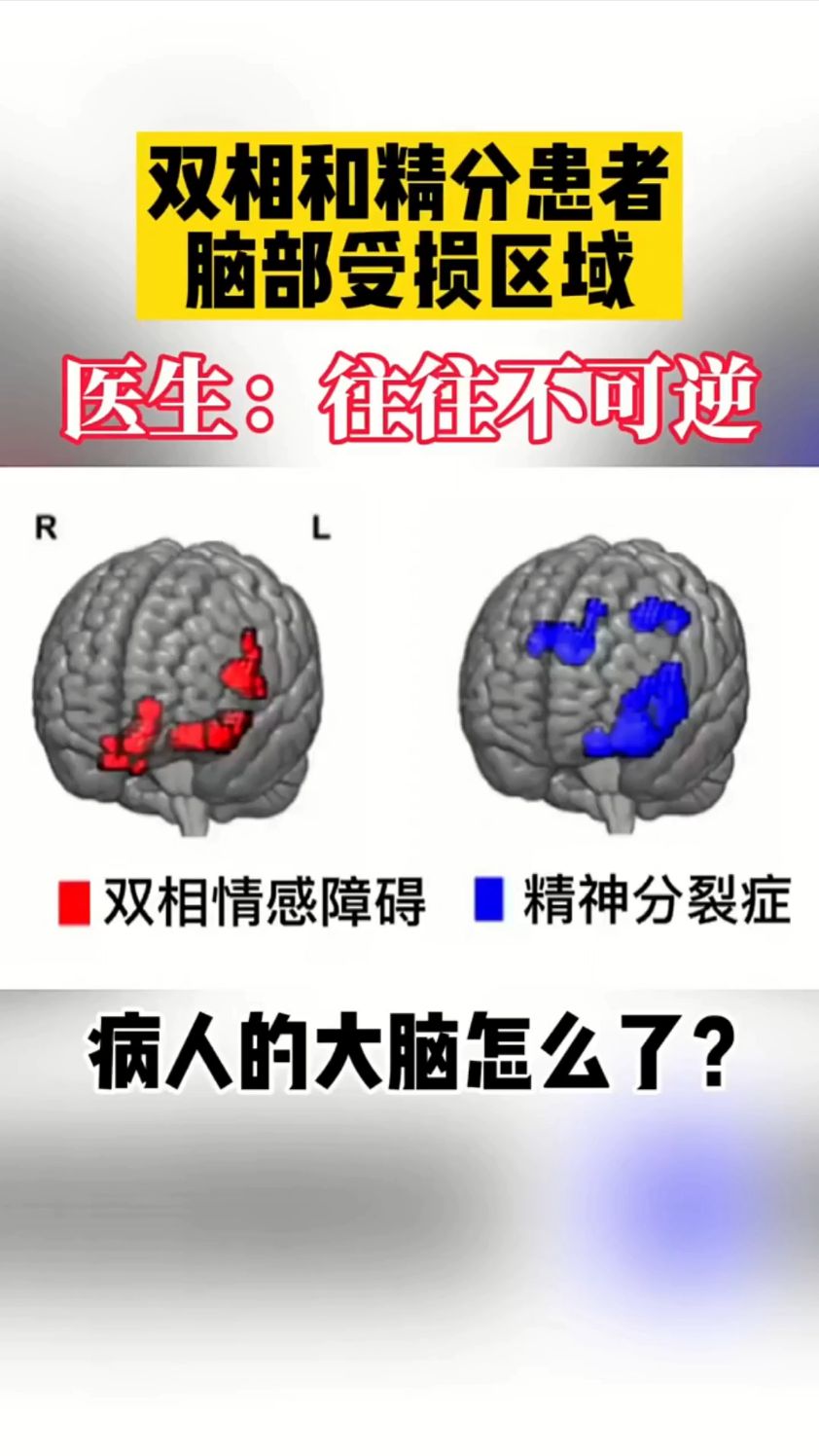 双相情感障碍和精神分裂得不到及时治疗,对大脑损伤会很严重!