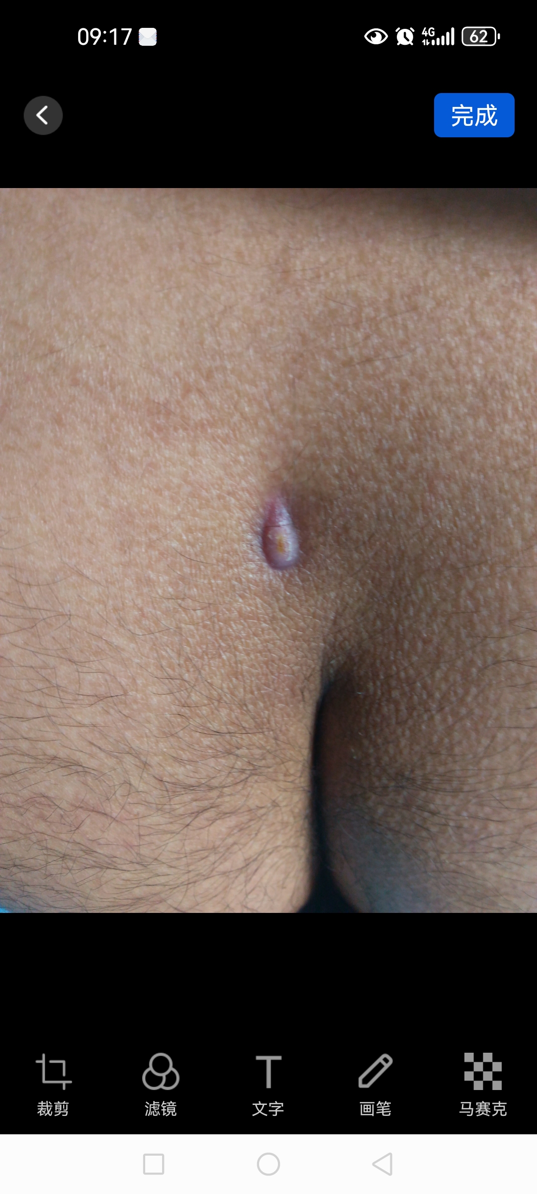 屁屁上的"青春痘"——藏毛窦!