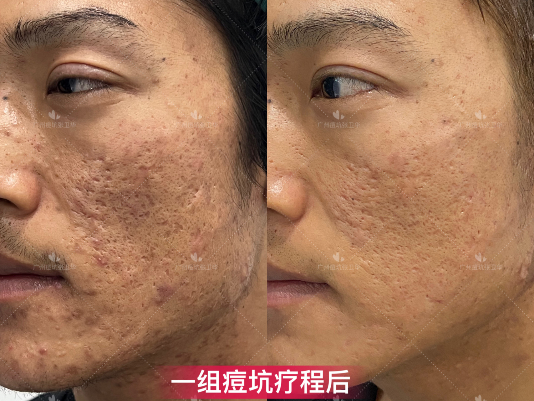 【严重痘痘痘印痘坑一组疗程后对比】 痘坑正确的对比方法能更好的