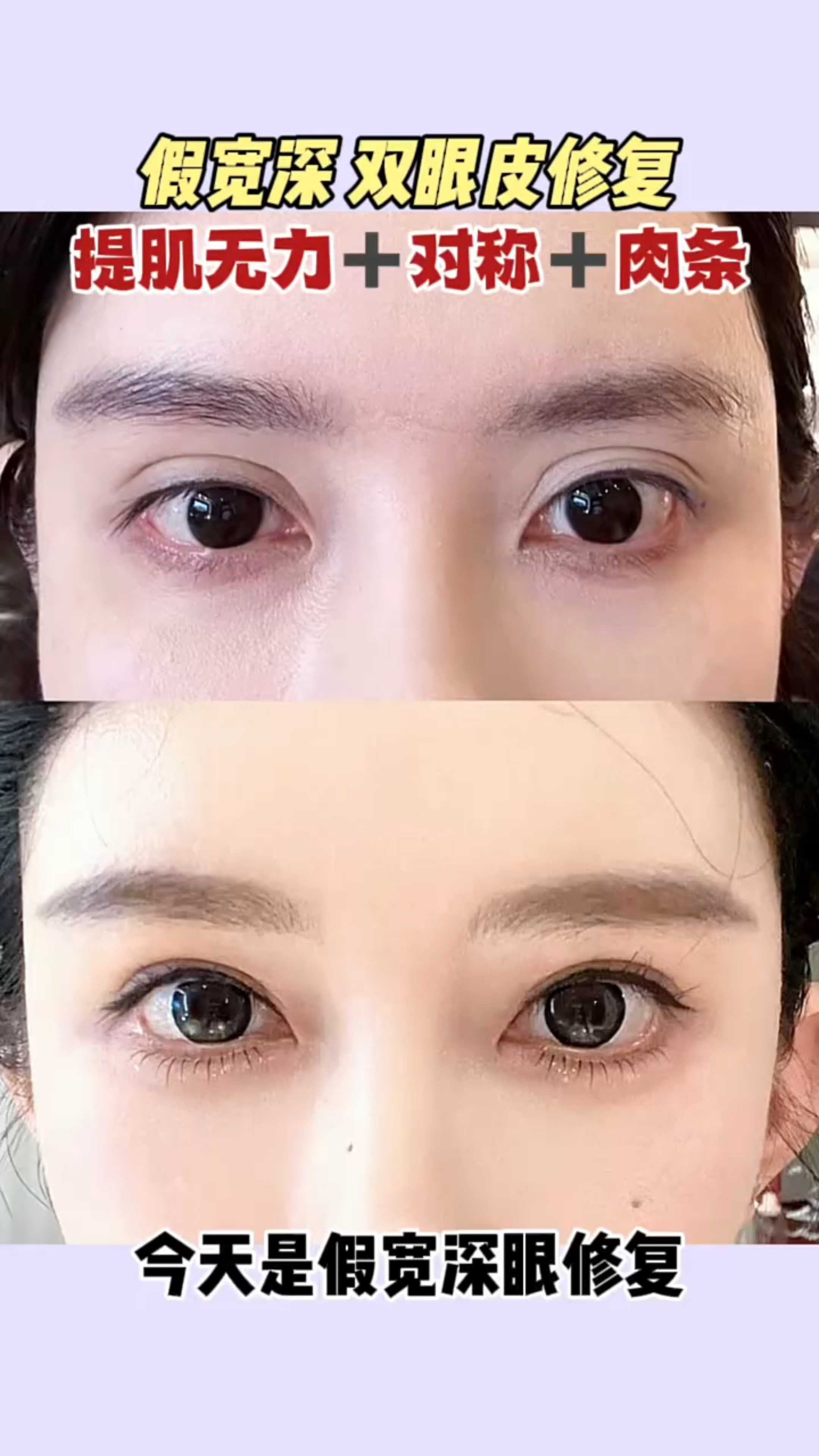 假宽深双眼皮修复,提肌无力和不对称修复-度小视