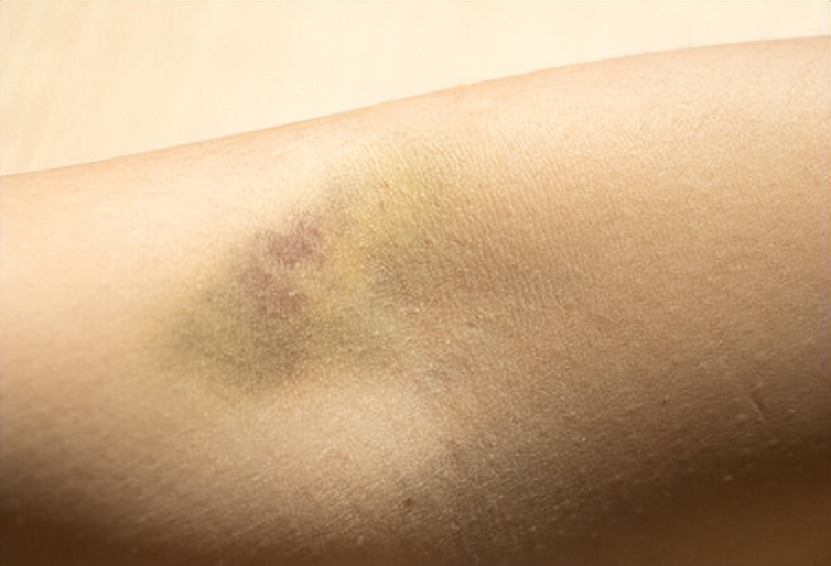 回顾贵州一男生出血瘀斑,确诊白血病,医生痛斥母亲无知惹的祸