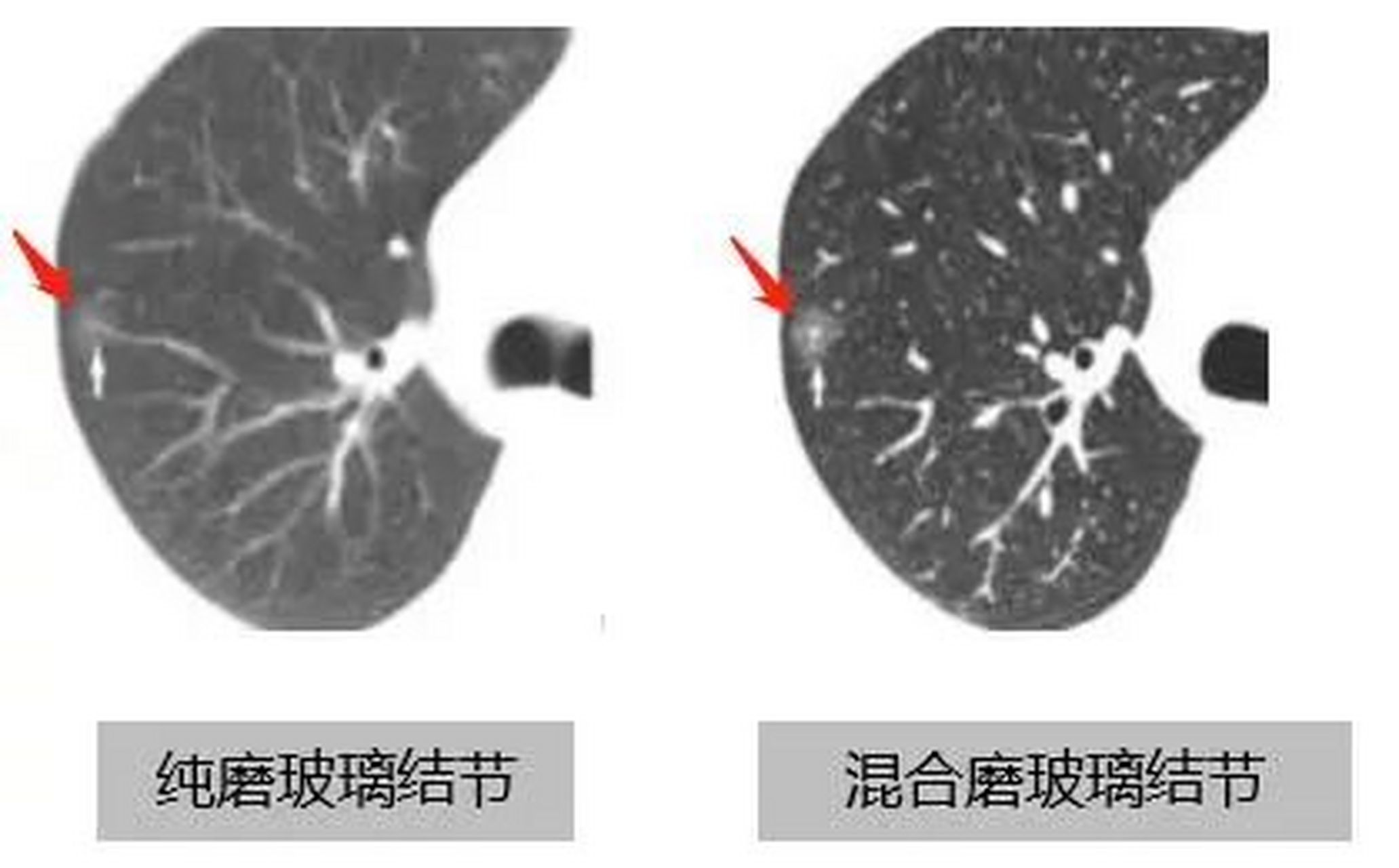 肺部结节常分为:磨玻璃结节,混合性结节,实性结节.