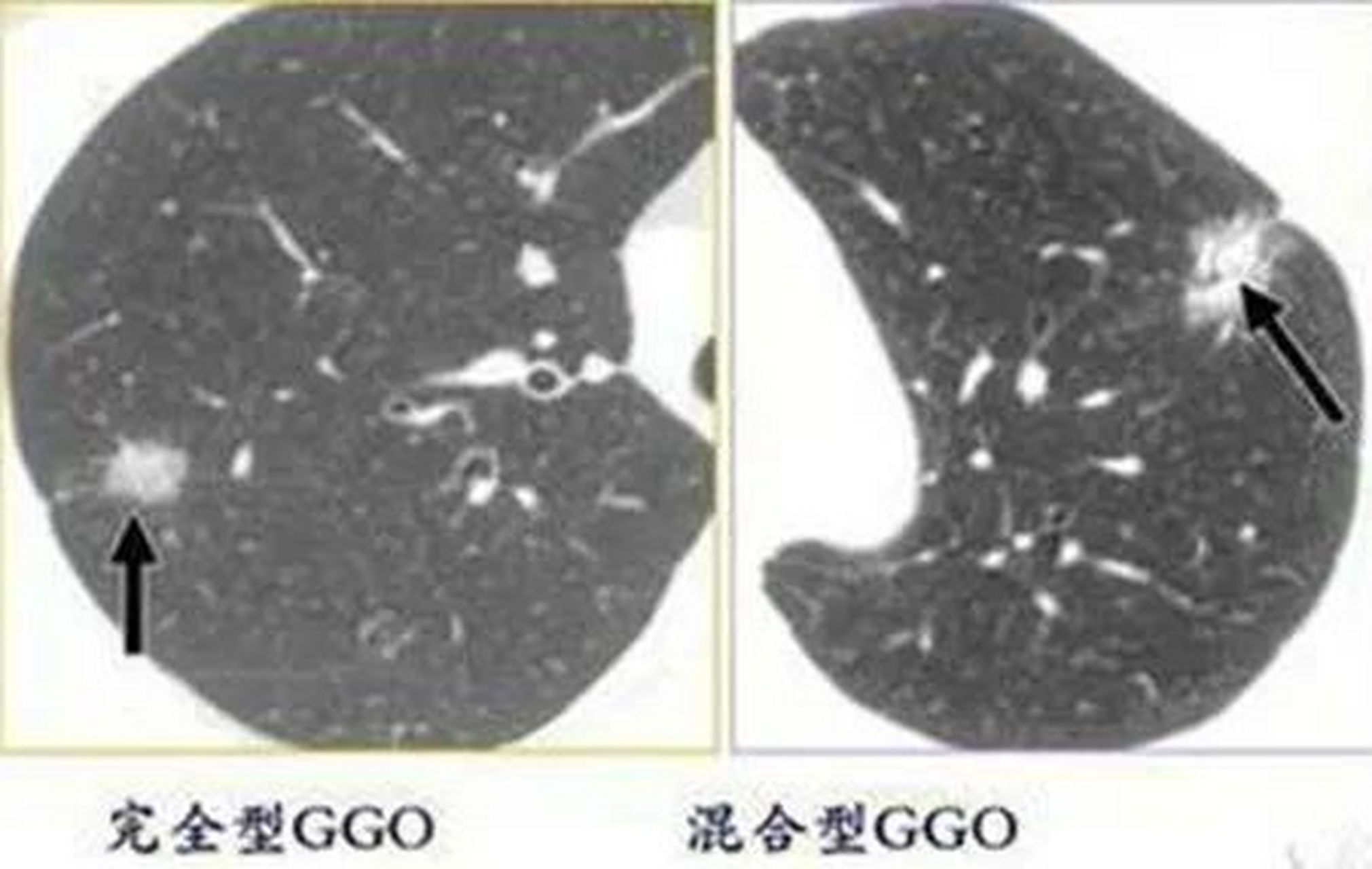 肺纤维灶磨玻璃结节图片