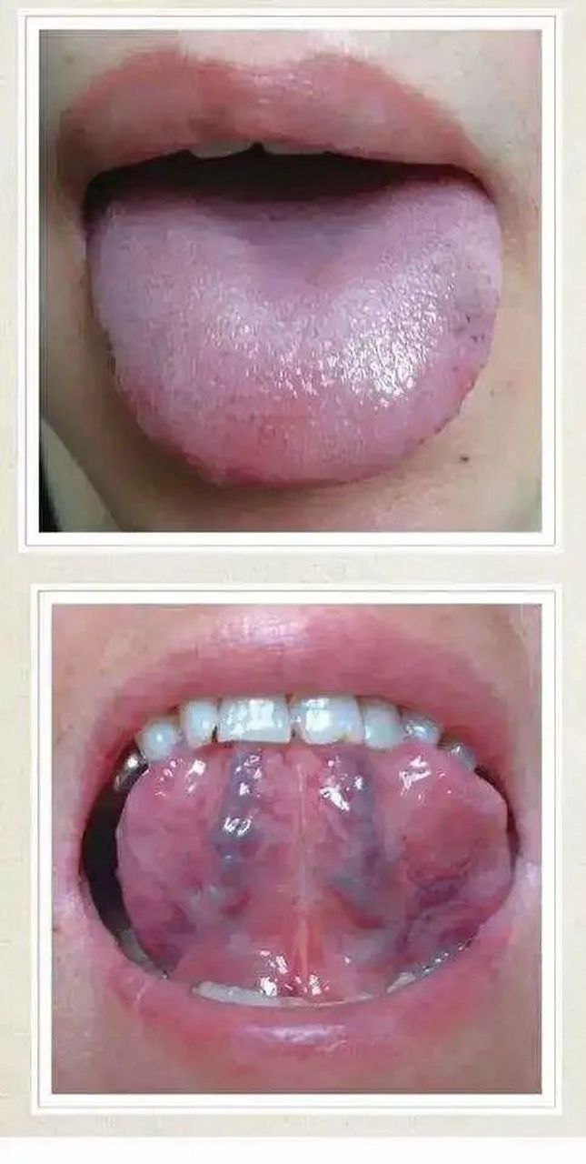 02 第二种:舌间不在中间,是歪的,说明舌头歪的那一侧头部出现了淤血