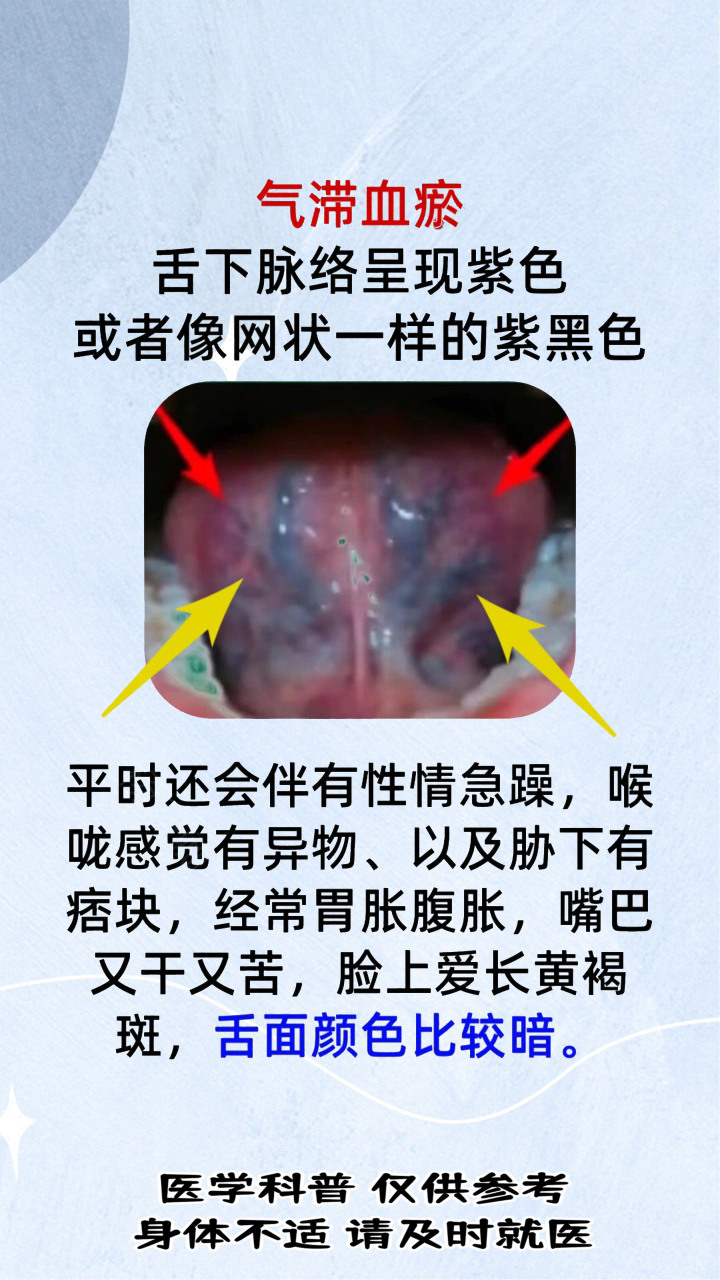 血瘀舌头图片比对图片