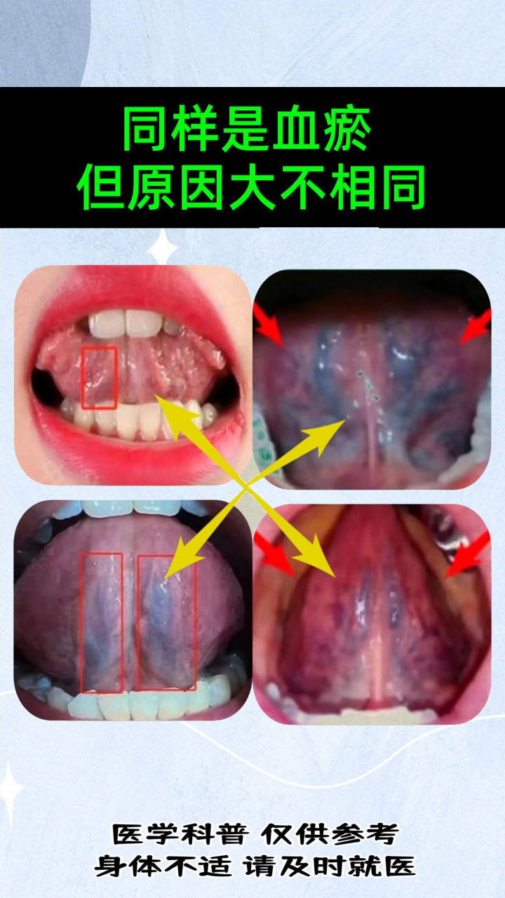 血瘀舌头图片比对图片