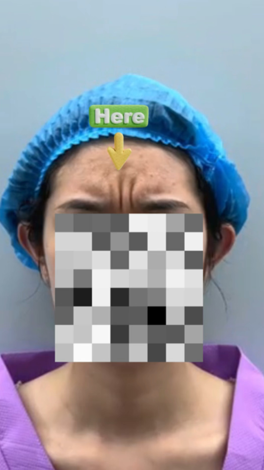 皱眉肌切除一个月后,我的川字纹淡多了-度小视
