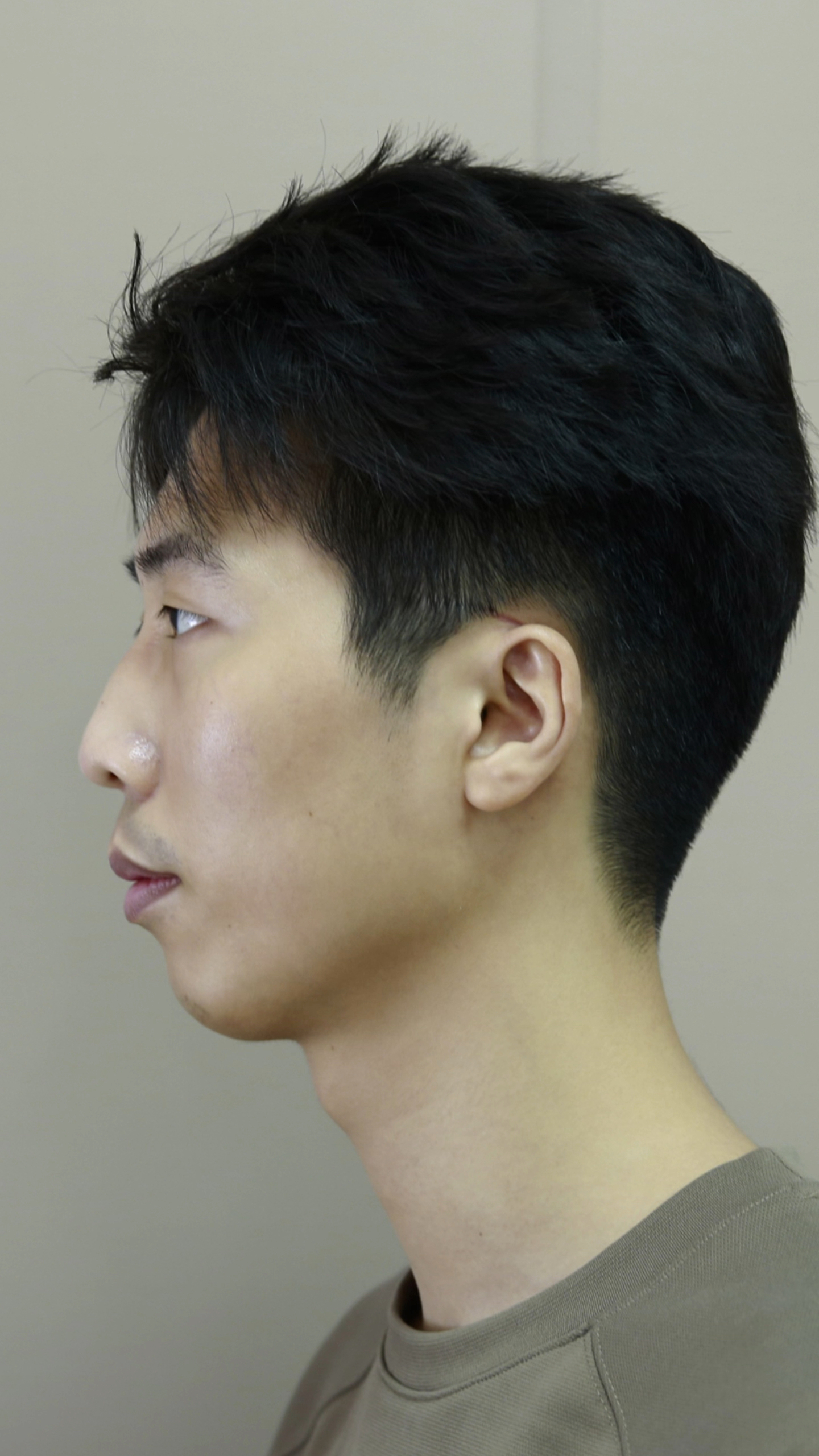 27男生凸嘴,下巴后缩矫正,正颌手术后15天的对比-度小视