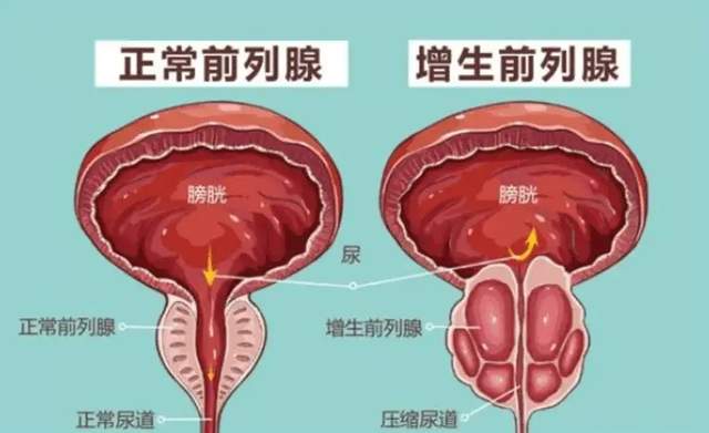 17年,46岁男子查出前列腺癌,流泪不止:早有信号,当时没重视