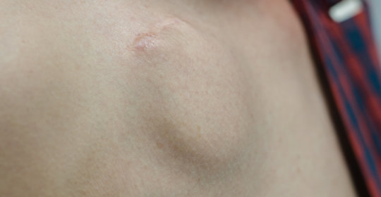 神经纤维瘤:症状,诊断与治疗