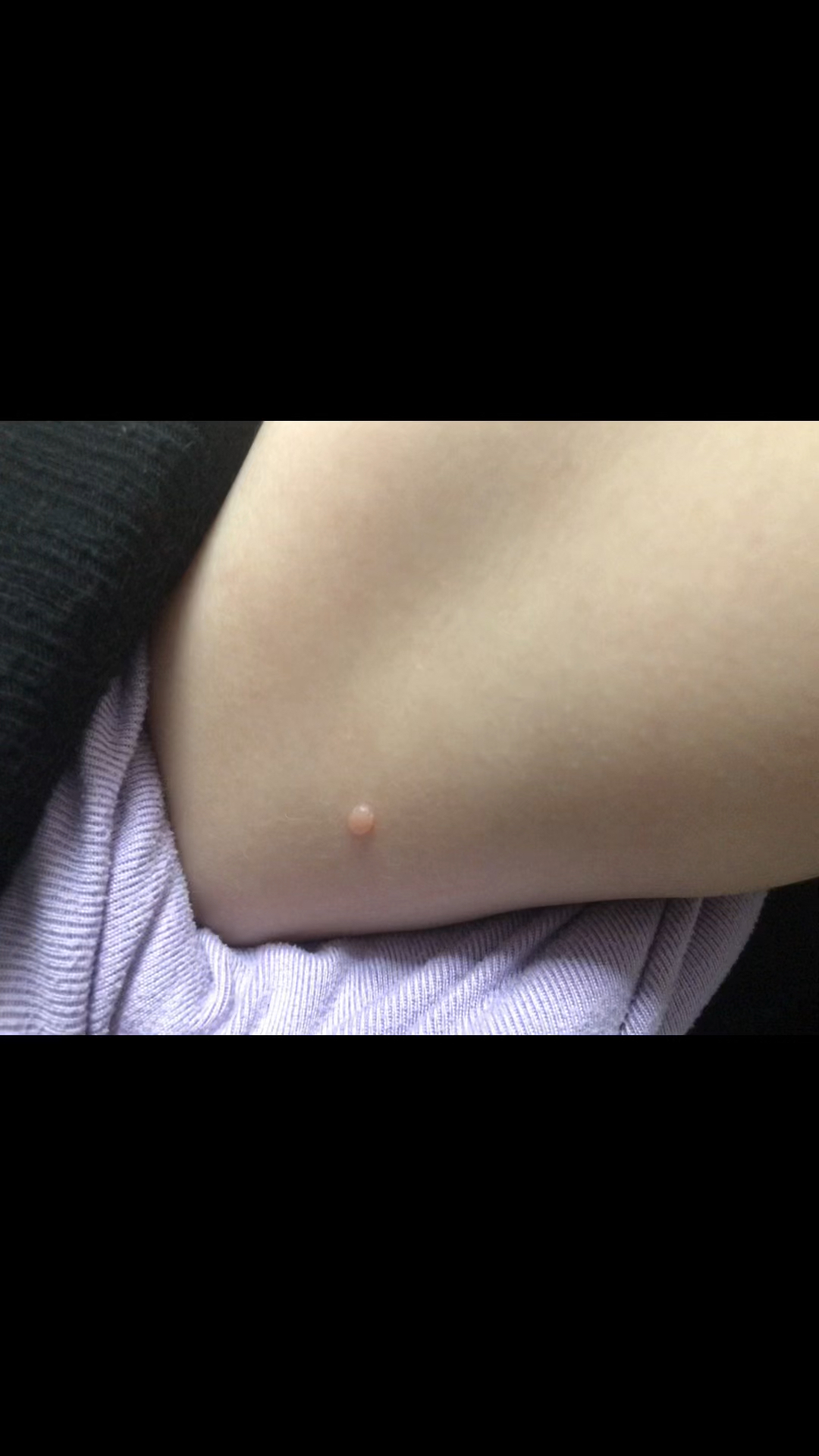 单发的传染性软疣