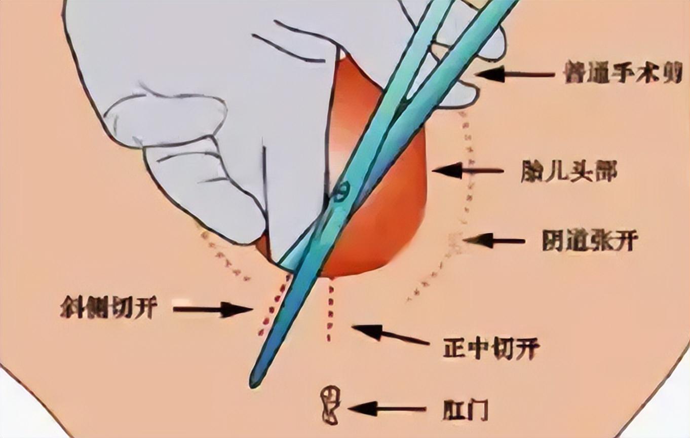 1984年因医生疏忽,一手术针滞留体内,32年后当事人:赔我100万