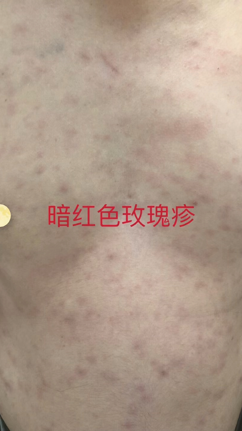 持续高热,玫瑰疹,焦痂需警惕丛林斑疹伤寒