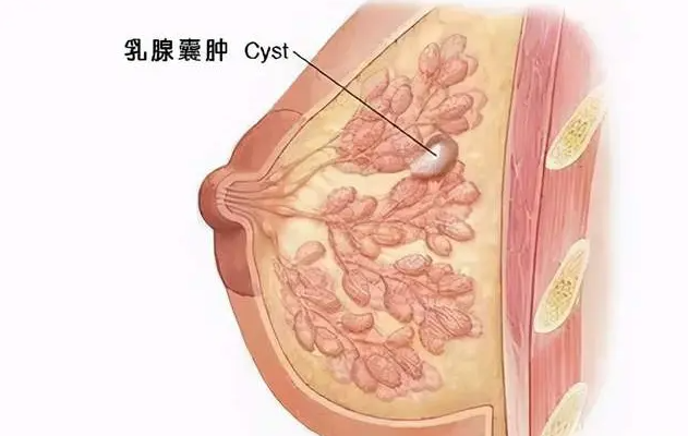 乳房疾病有哪些图片