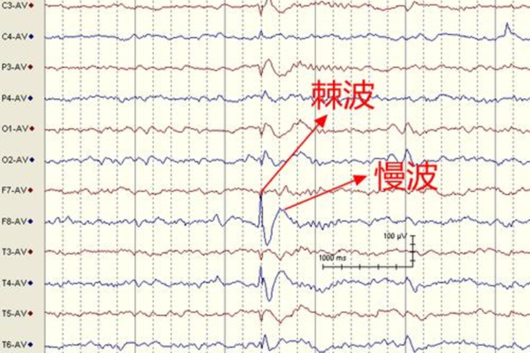 脑电图异常就是脑子一定有问题吗