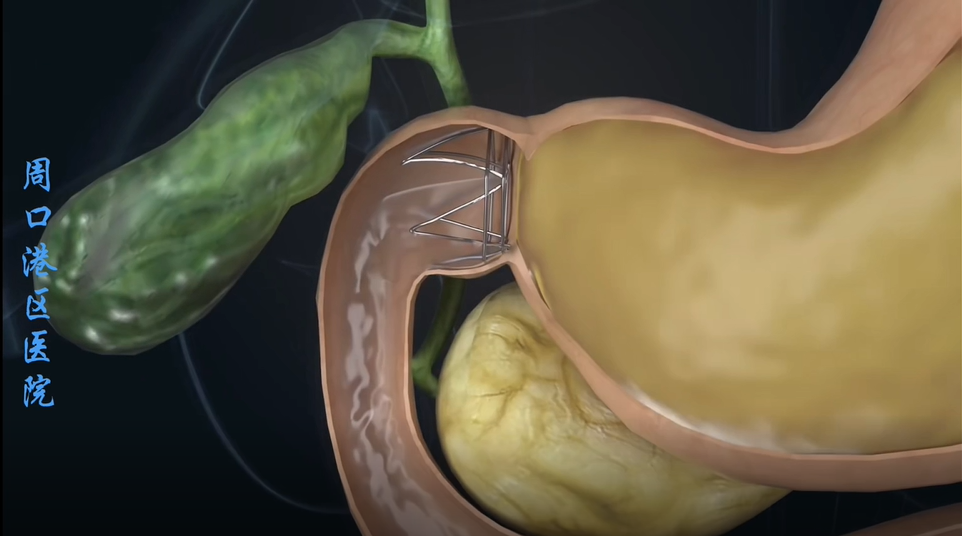 河南省首例胃转流支架在周口港区医院完成置入应用