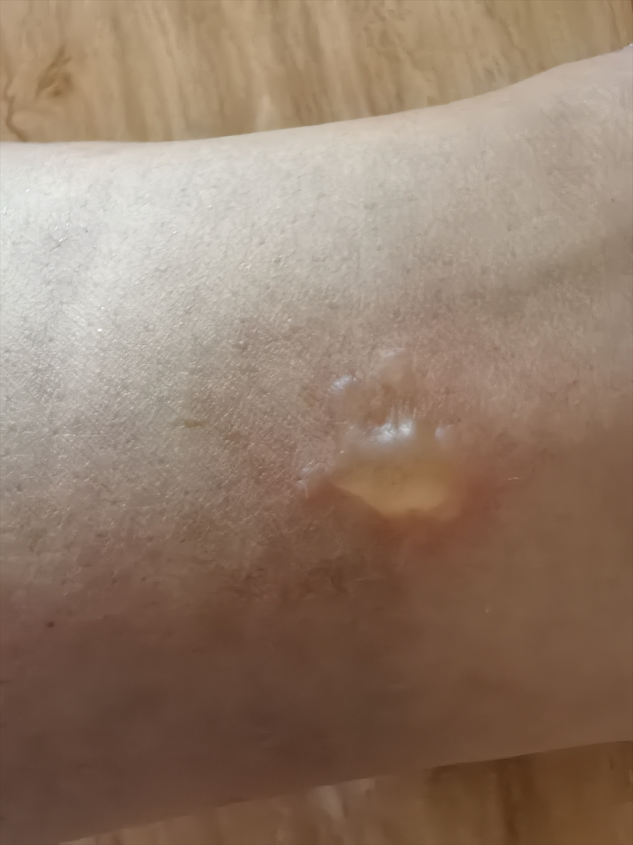 艾灸三阴交,竟然灸出了一个水泡?是shi气吗?