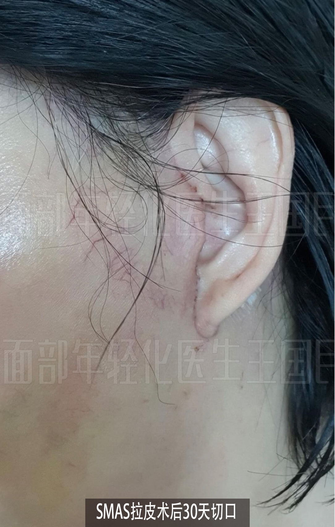 隐蔽切口smas拉皮术后30天切口