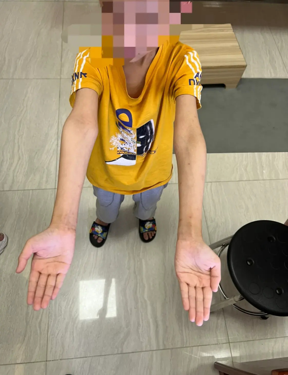 家长说,从小没有任何问题,但三年前突然发现,右侧手