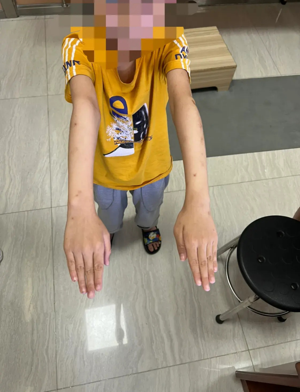 家长说,从小没有任何问题,但三年前突然发现,右侧手臂内翻了,而且后来