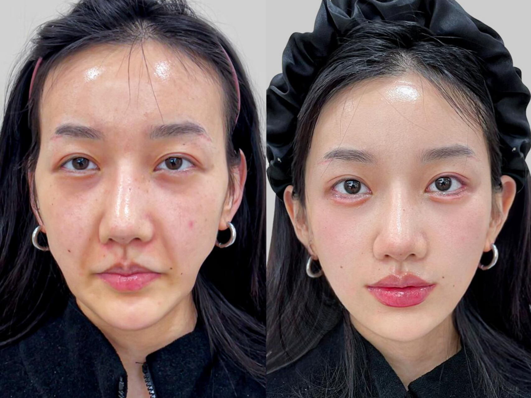 45岁做完提升,被误以为是大学生  今天面诊的这位女