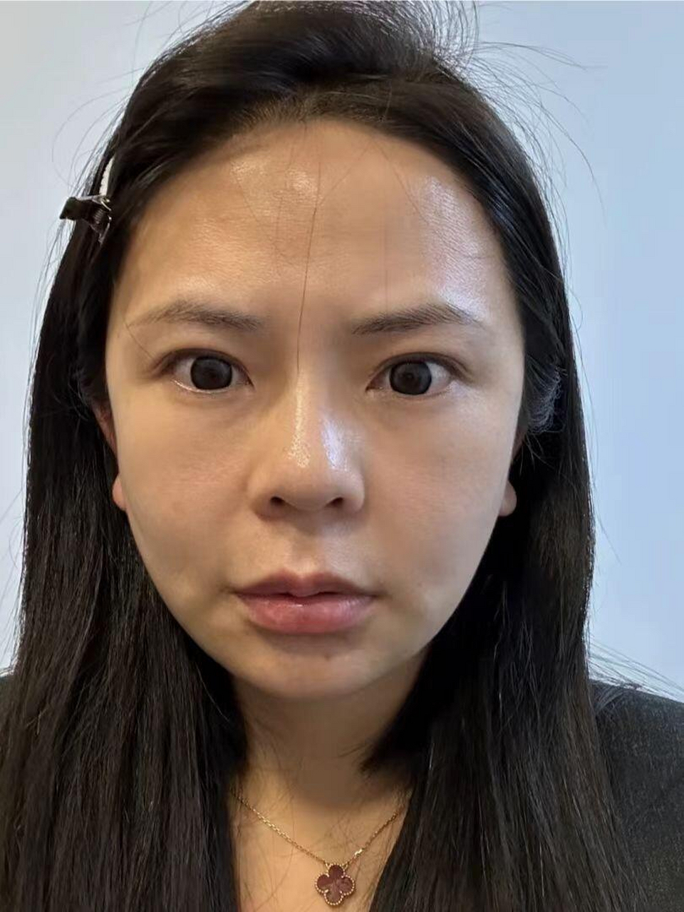 去成都做医美,整成这样,后悔惨了  1年前做过线雕,面部变得坑坑洼洼的