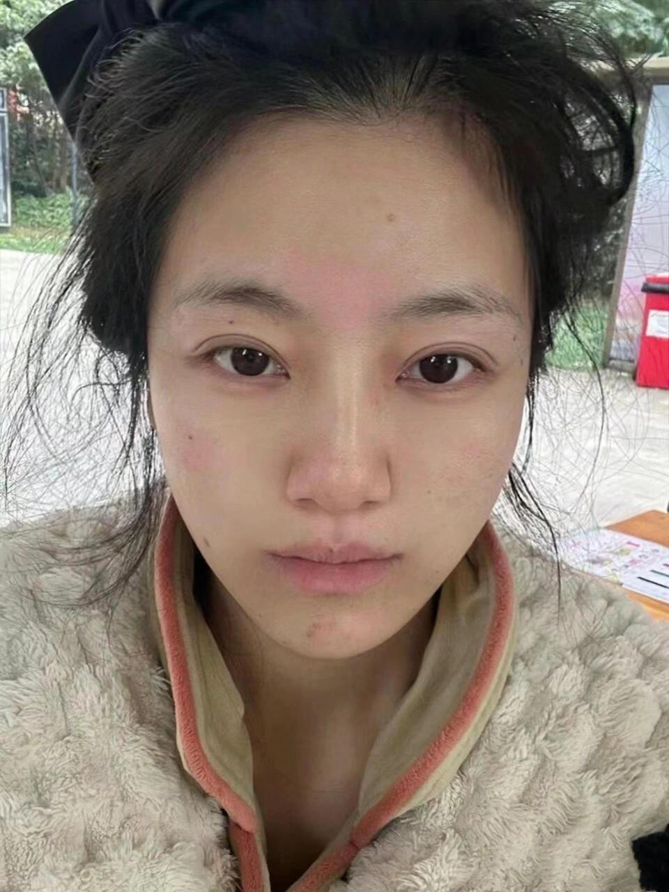 后面终于鼓起勇气去做了医美,把脸型调整了,朋友都说现在很幼态不克夫