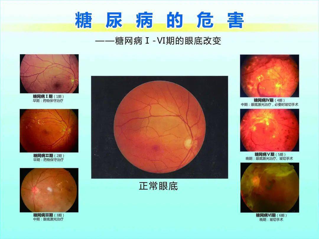 眼睛出现这8个症状,警惕糖尿病眼病,严重时可导致失明!