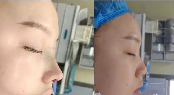 蒜头鼻缩小整形多少钱  我蒜头鼻还是比较明显的,在朋友建议下我去做