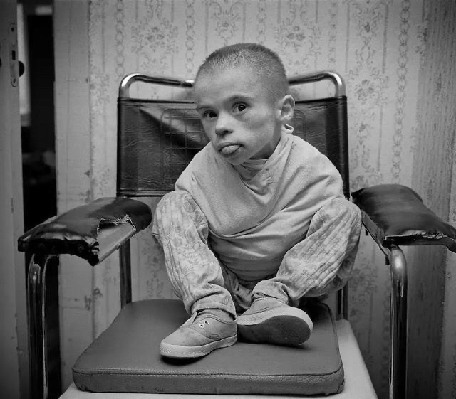 那些年,得了核辐射病的人,如今怎么样了?