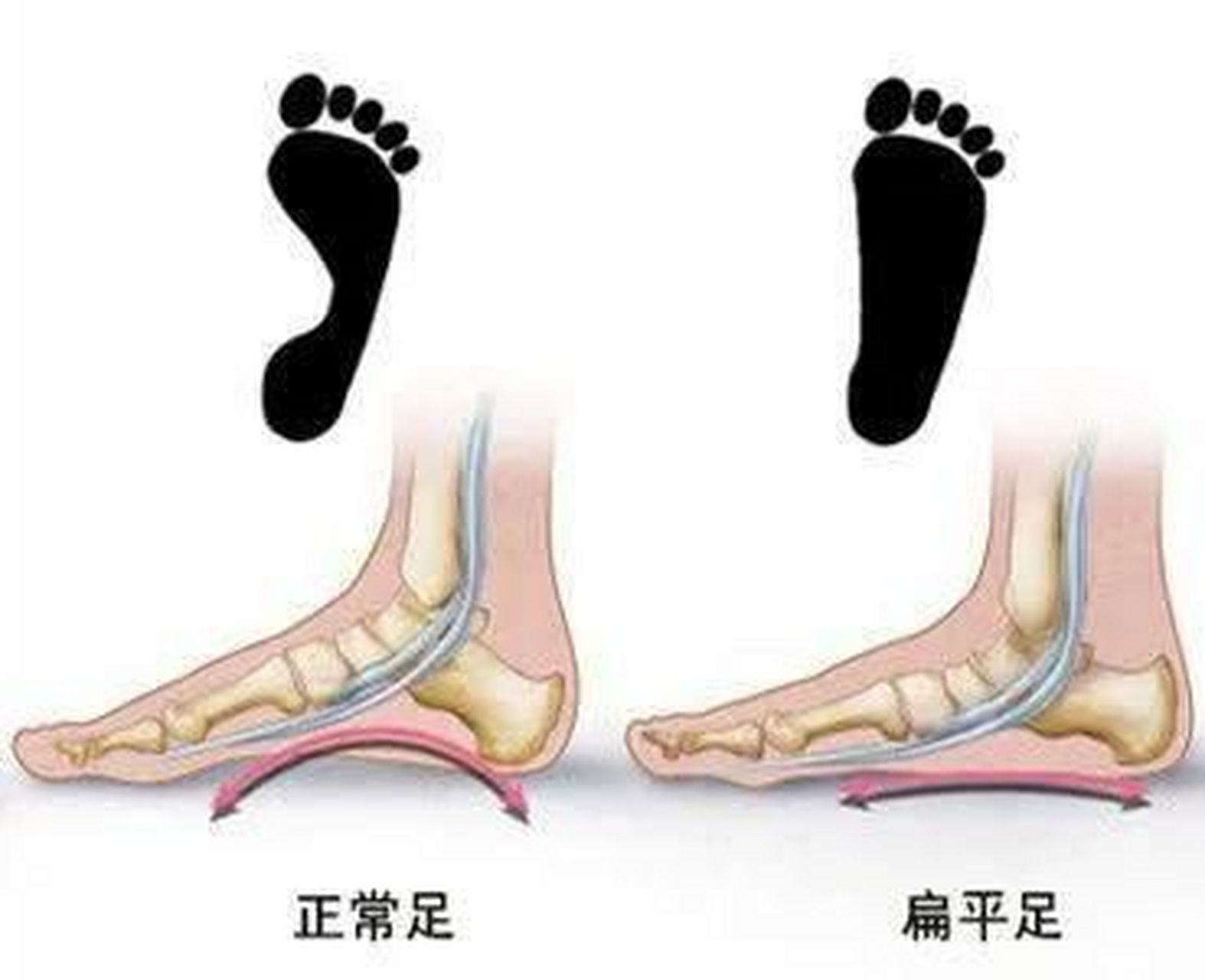 拇外翻导致足弓塌陷的原因主要有以下几点:  生物力学改变:拇外翻会