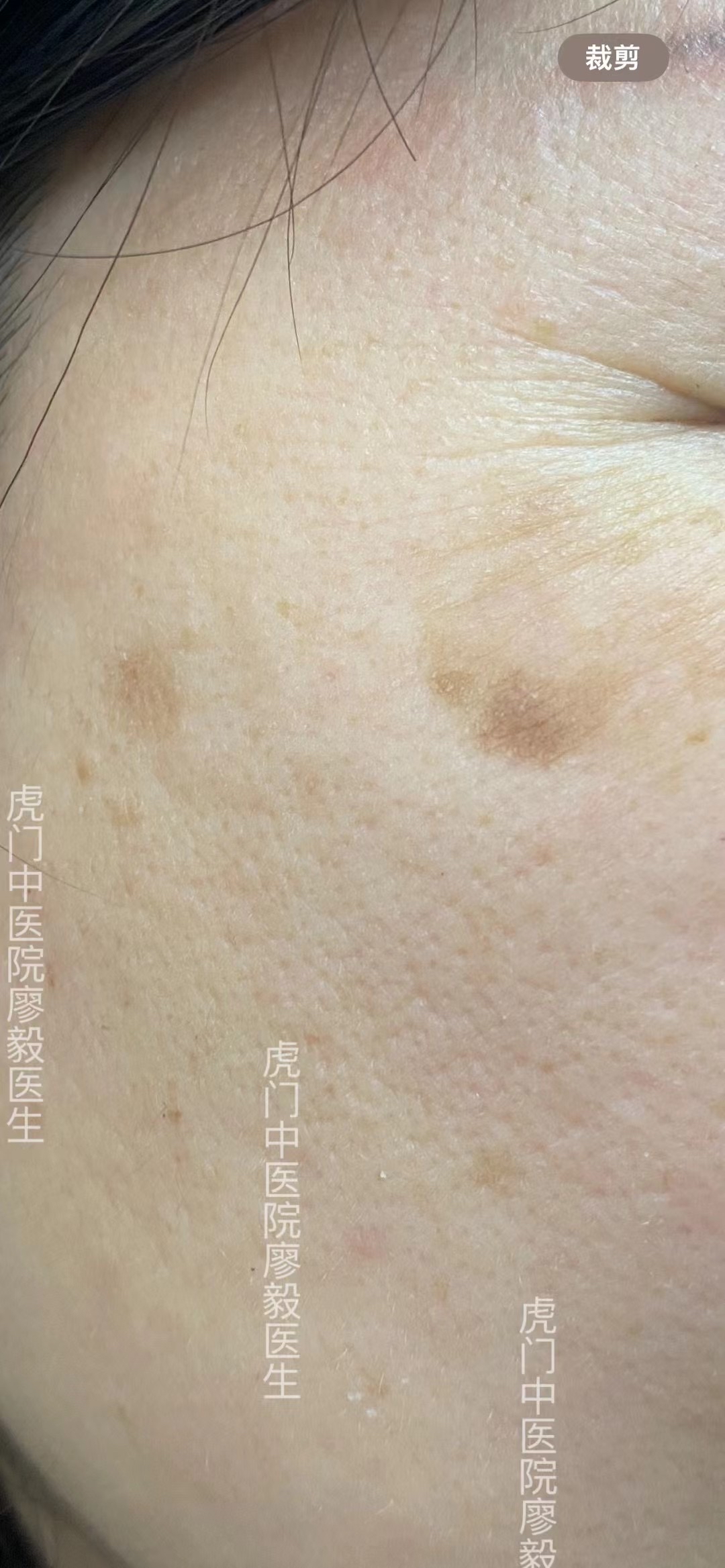 老人斑,老年疣