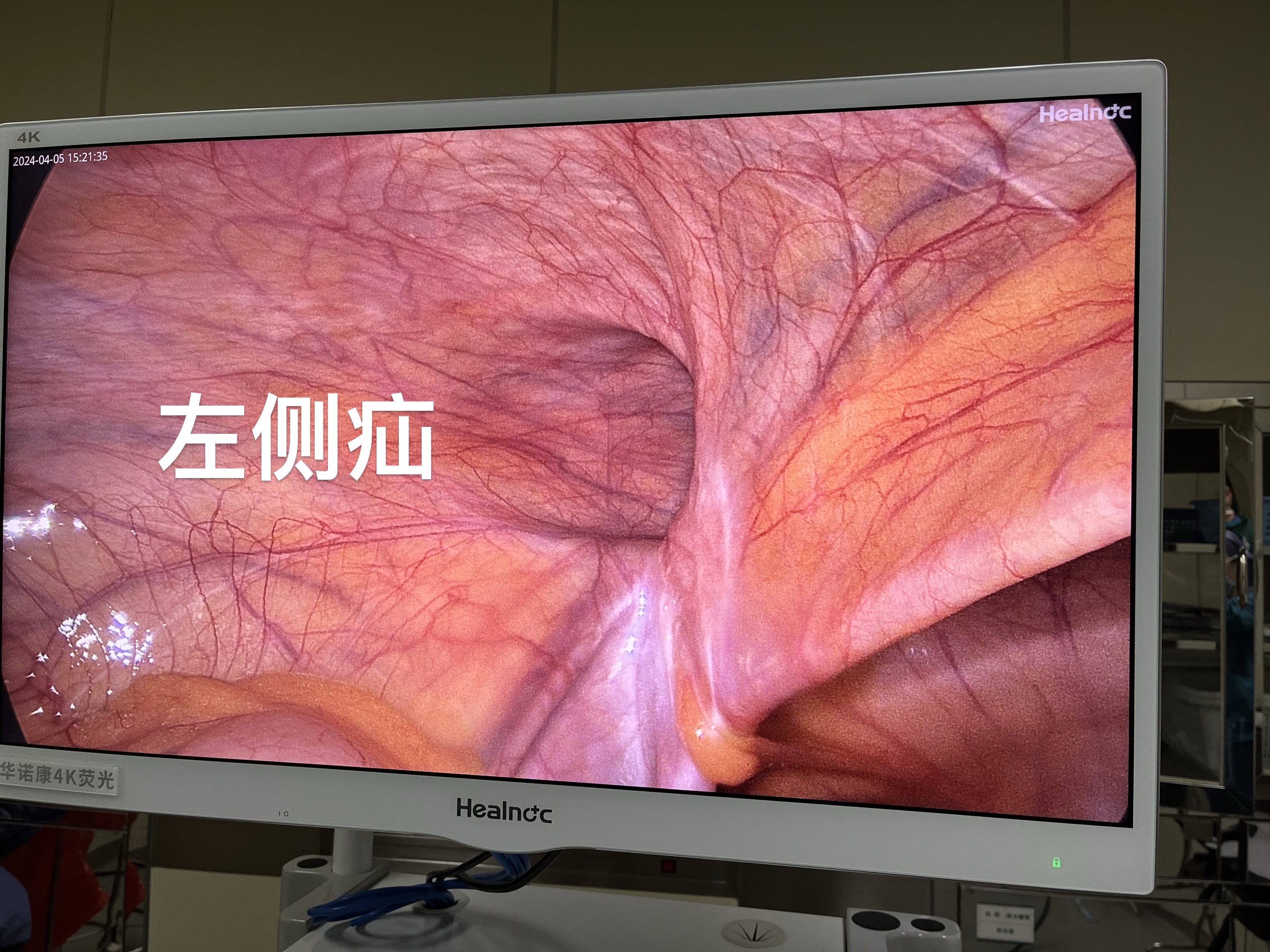 什么是腹股沟疝,腹腔镜下视角