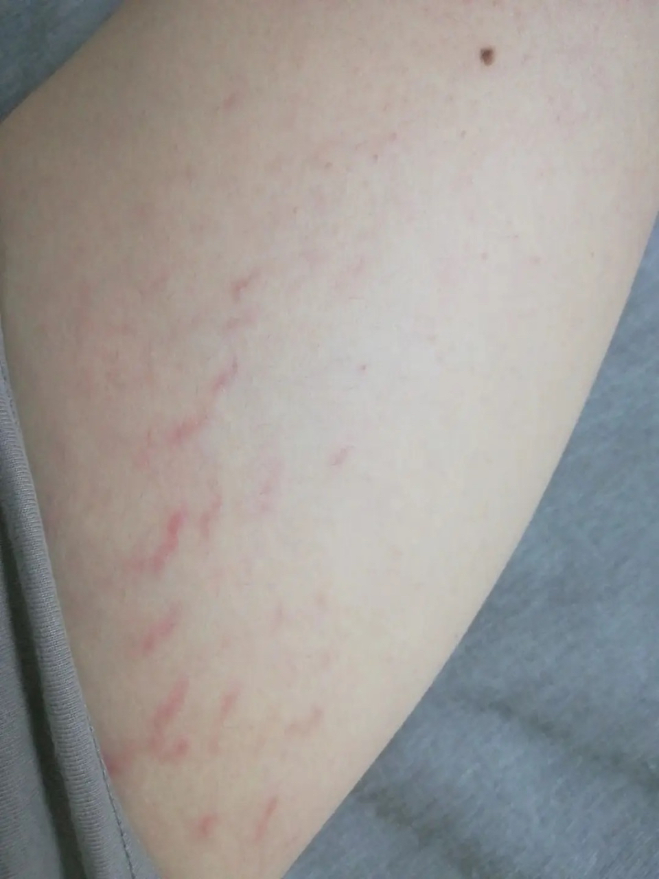 肥胖纹激光多少钱?