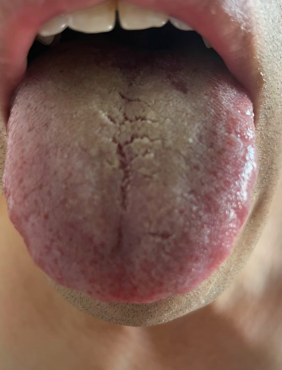 健脾胃之前,一定要先清理舌苔 !