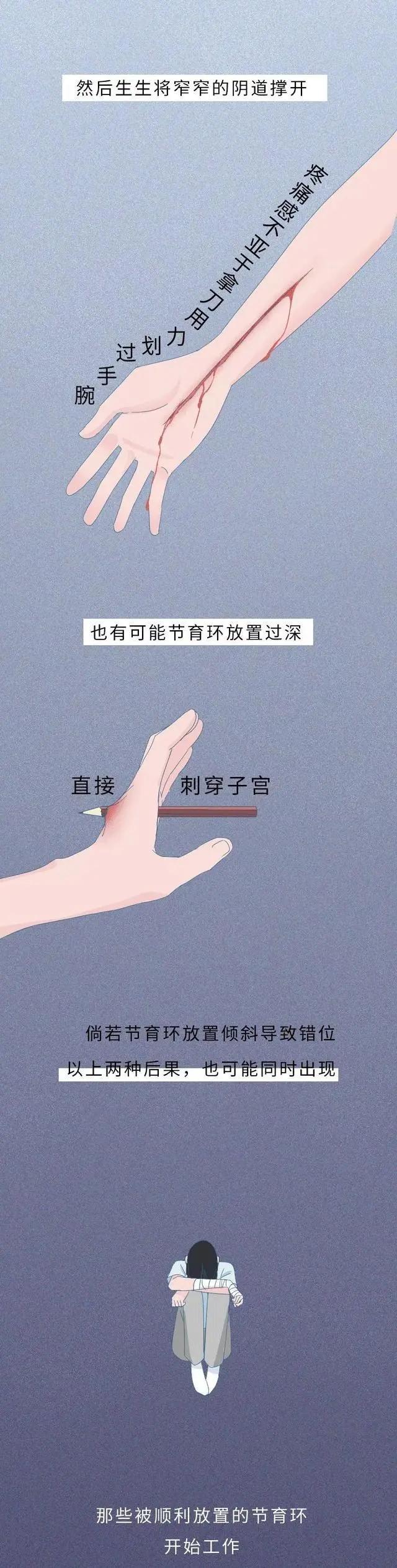 节育环在女性体内的20年