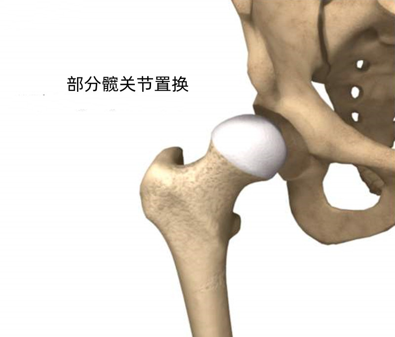 髋关节置换 换掉整个髋关节